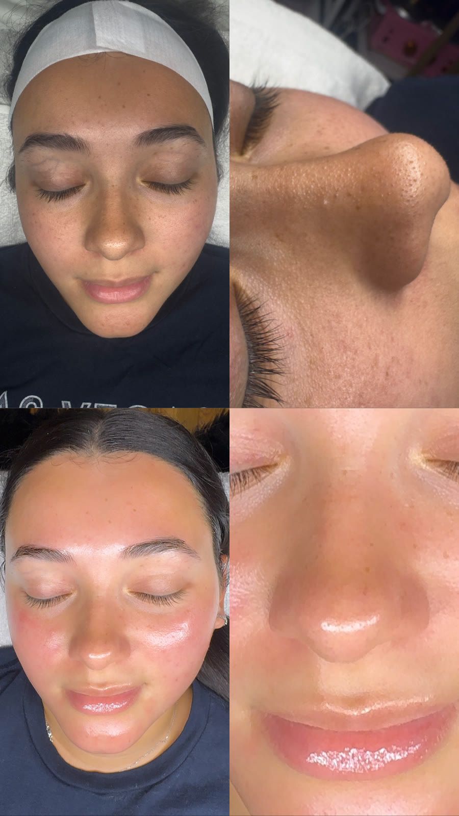 Client skin before and after treatment