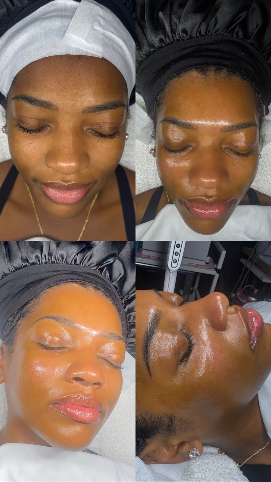 Client skin before and after treatment