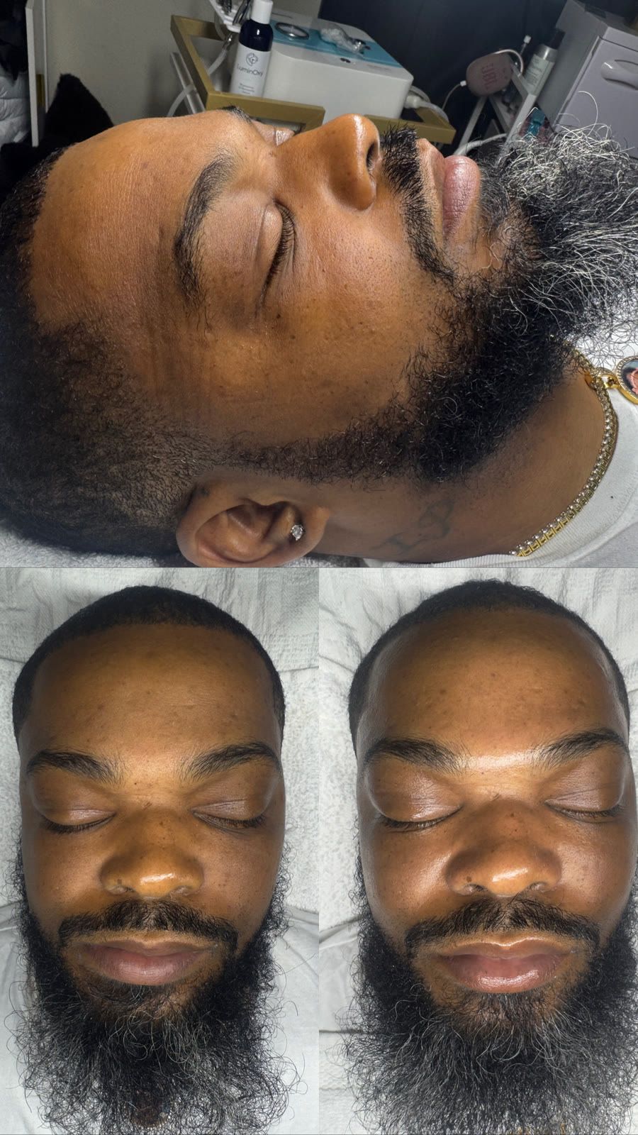 Client skin before and after treatment